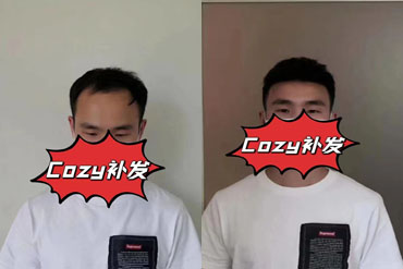 四川小哥织发补发后满意的不容言表